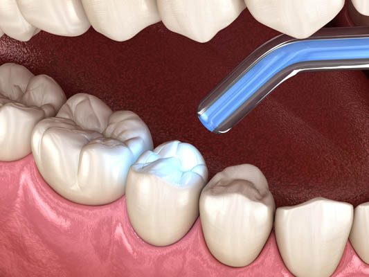 Can Dental Fillings Treat Tooth Decay? - Arc Advanced Dentistry